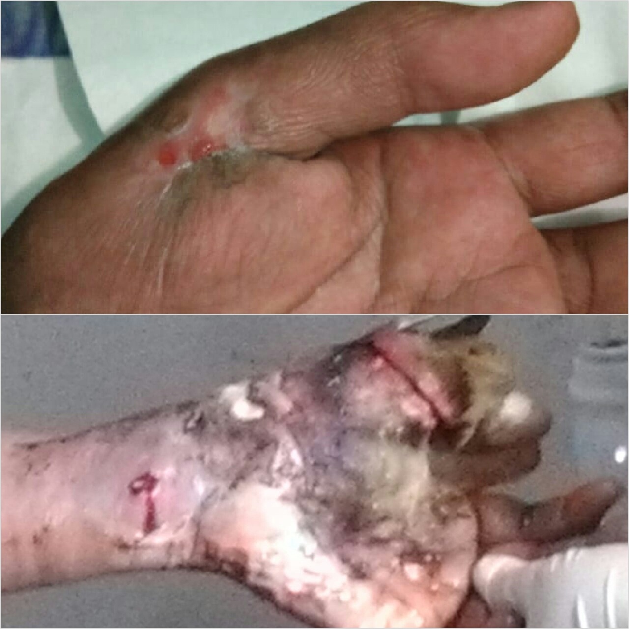 Hasil perawatan luka diabetes