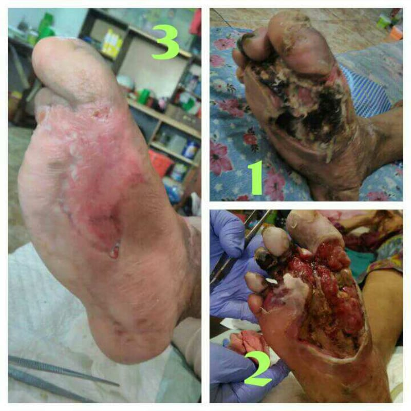 Hasil perawatan luka pasca caesar